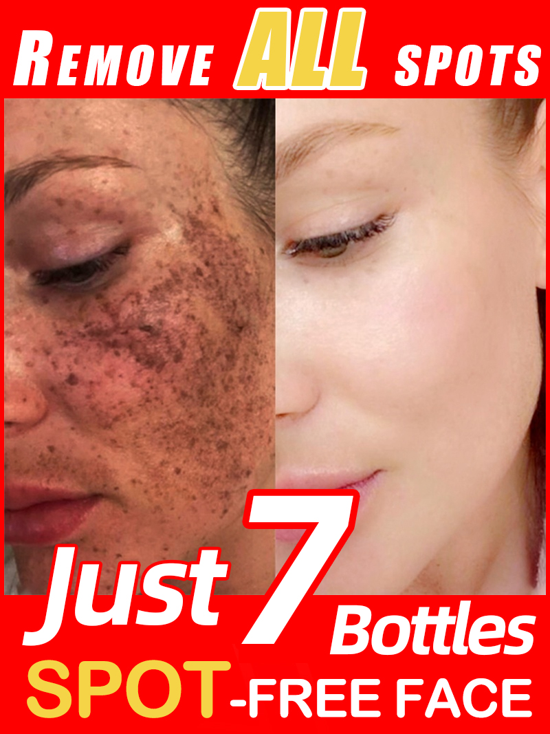 Skincare Luxury Whitening - Mencerahkan Bintik-Bintik, Melasma, Flek Hitam di